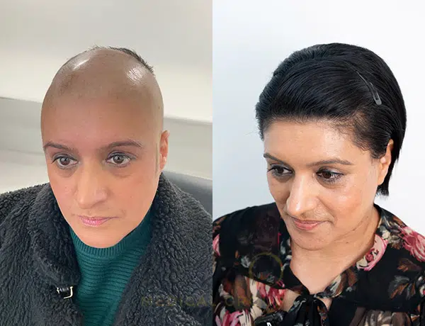 Alopecia Treatment Results